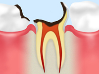 C4【歯根まで達したむし歯】